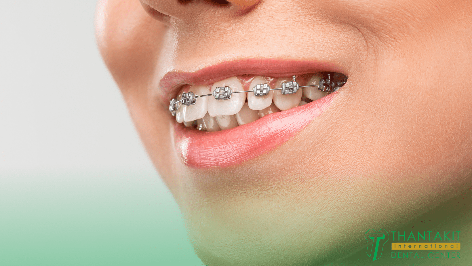 What are the types of braces?