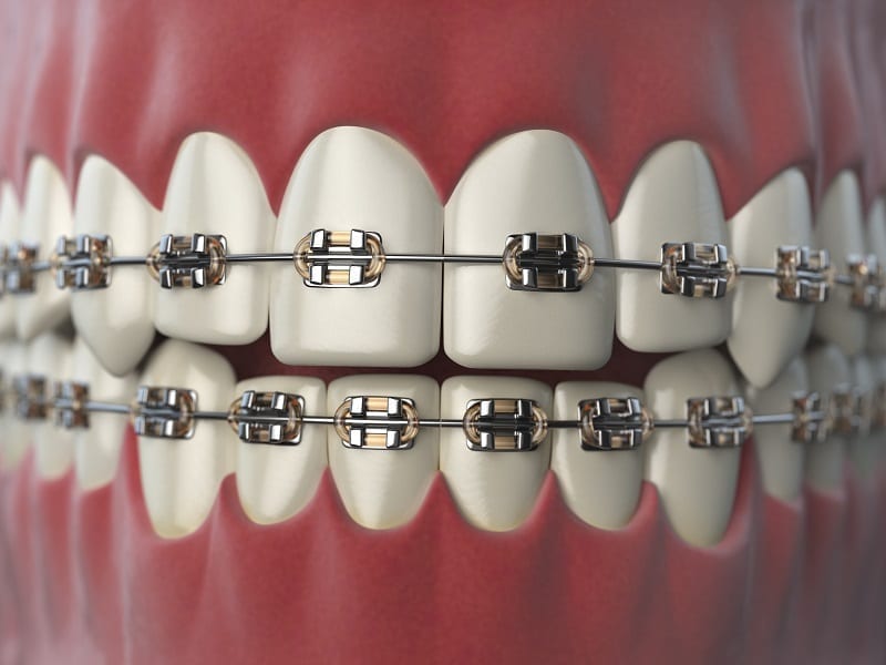 Dental Braces – Their Types and Costs