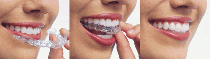 Clear Aligners, Invisible Braces - San Jose Dental Services