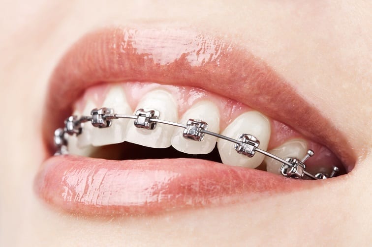 Orthodontic Braces: Types & How do they work?