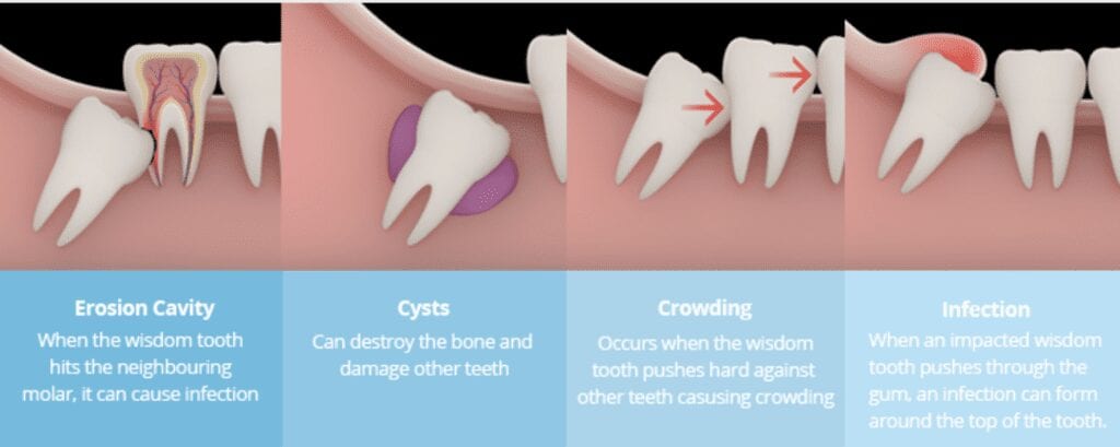 Wisdom Tooth Extraction 6 Facts You Need To Know - Riset