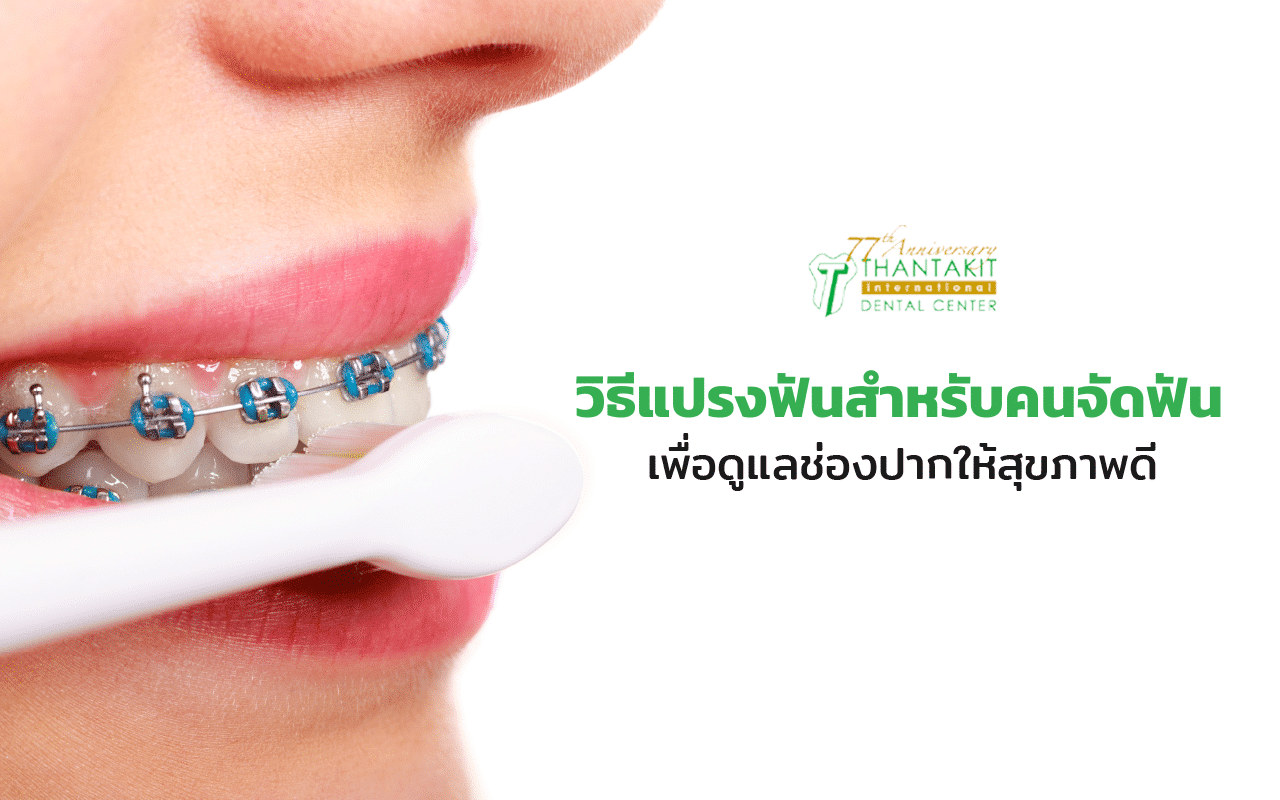 วิธีแปรงฟันสำหรับคนจัดฟัน เพื่อดูแลช่องปากให้สุขภาพดี | ศูนย์ทันตกรรมทันตกิจ