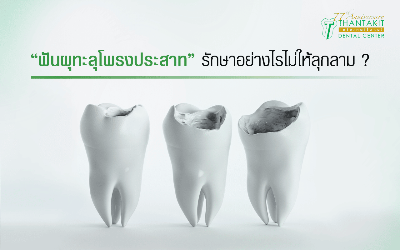 ฟันผุทะลุโพรงประสาท