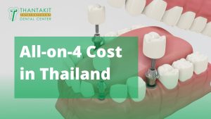 All-on-4-Cost-in-Thailand.jpg