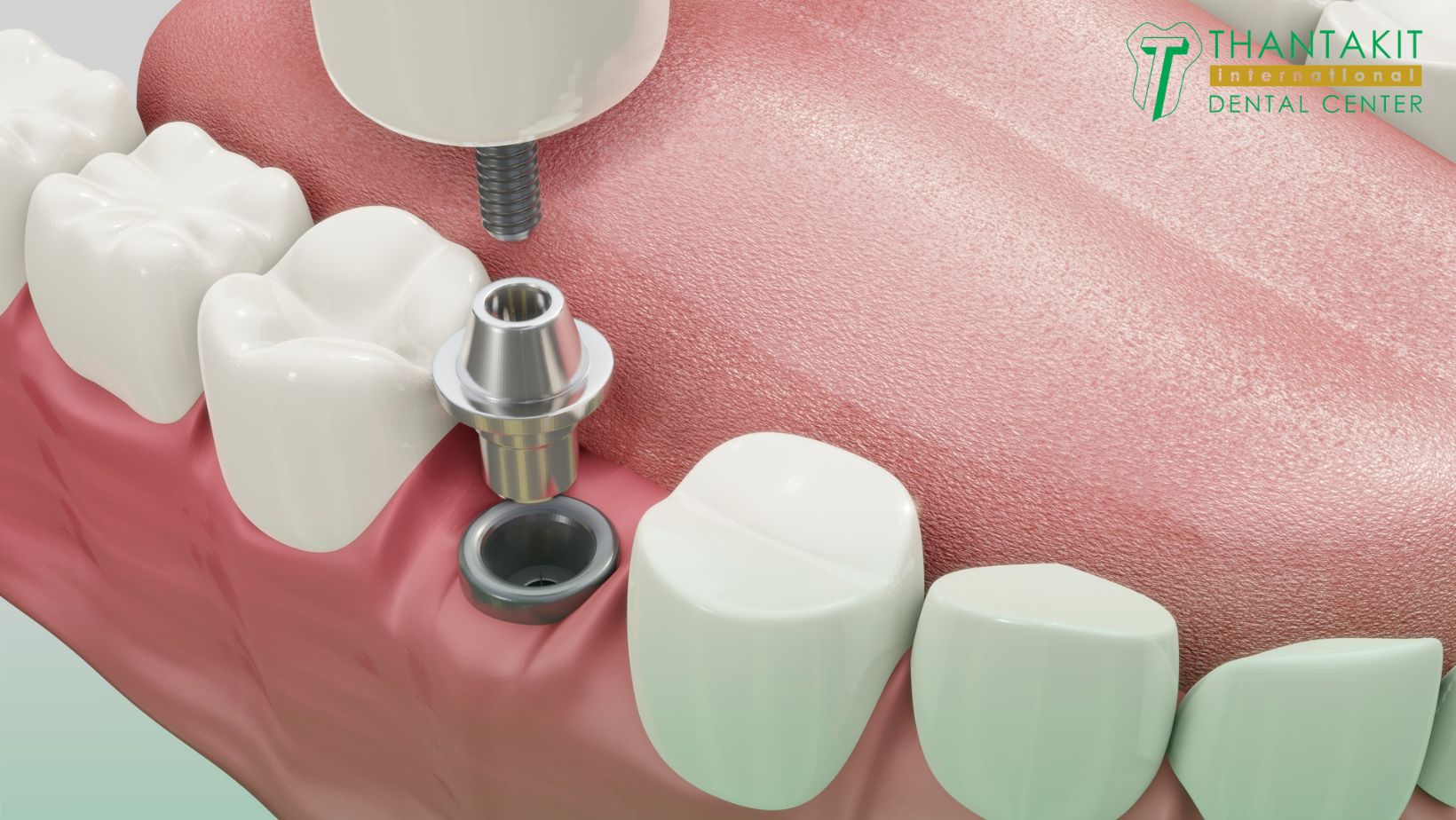 Average-All-on-4-Implant-Costs-in-Thailand-1.jpg