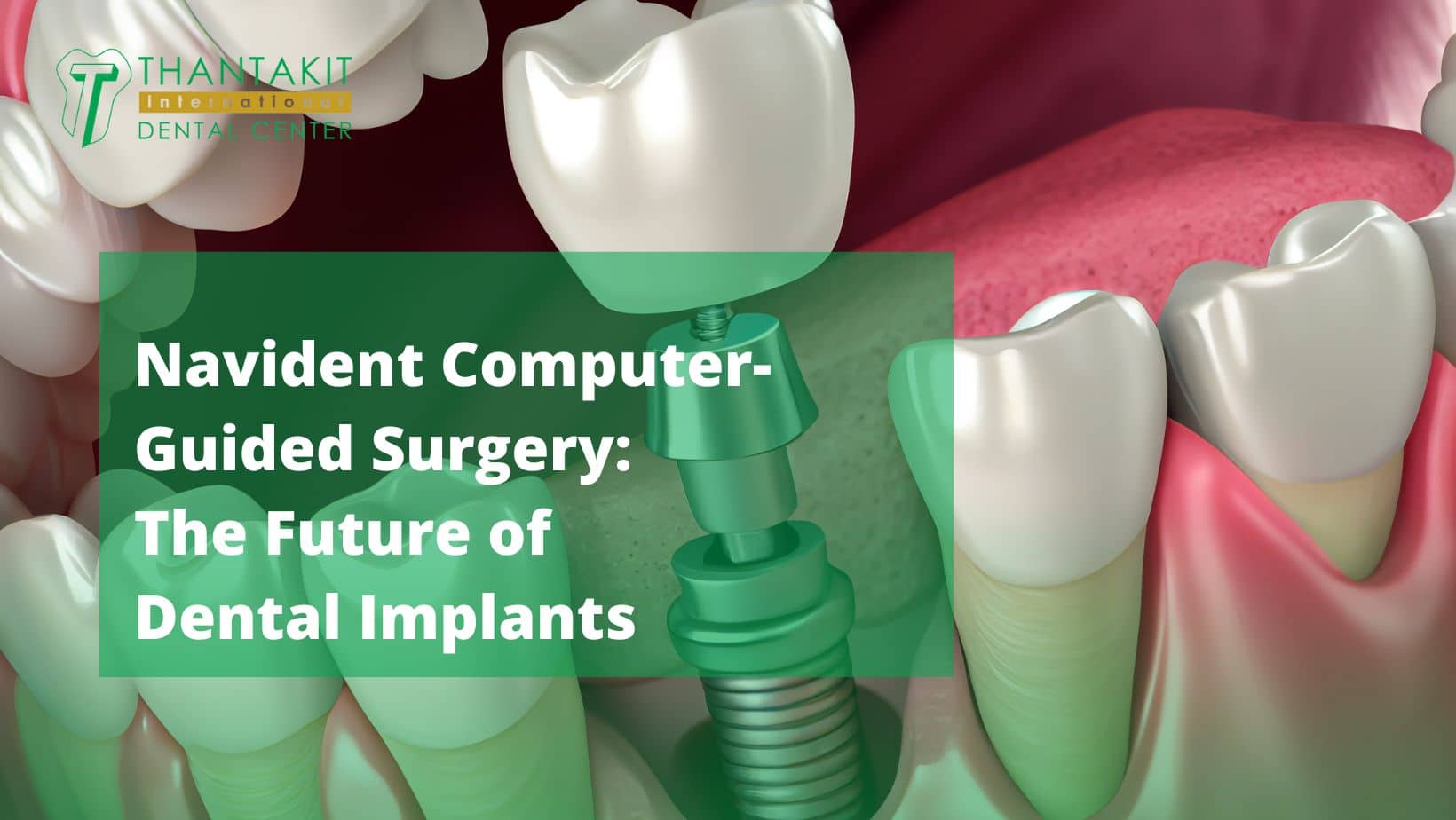 Navident Computer-Guided Surgery The Future of Dental Implants